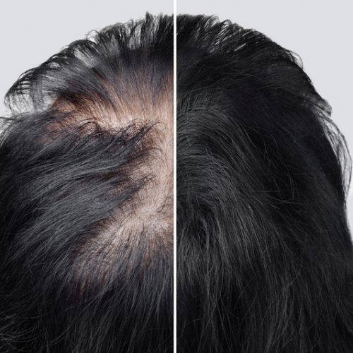 Women baldness alopecia. Hair after using cosmetic powder to thicken hair. Before and after. Women baldness alopecia. Hair after using cosmetic powder to thicken hair. Before and after.